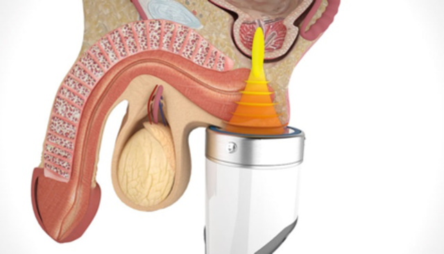 Kronik Prostatit 3